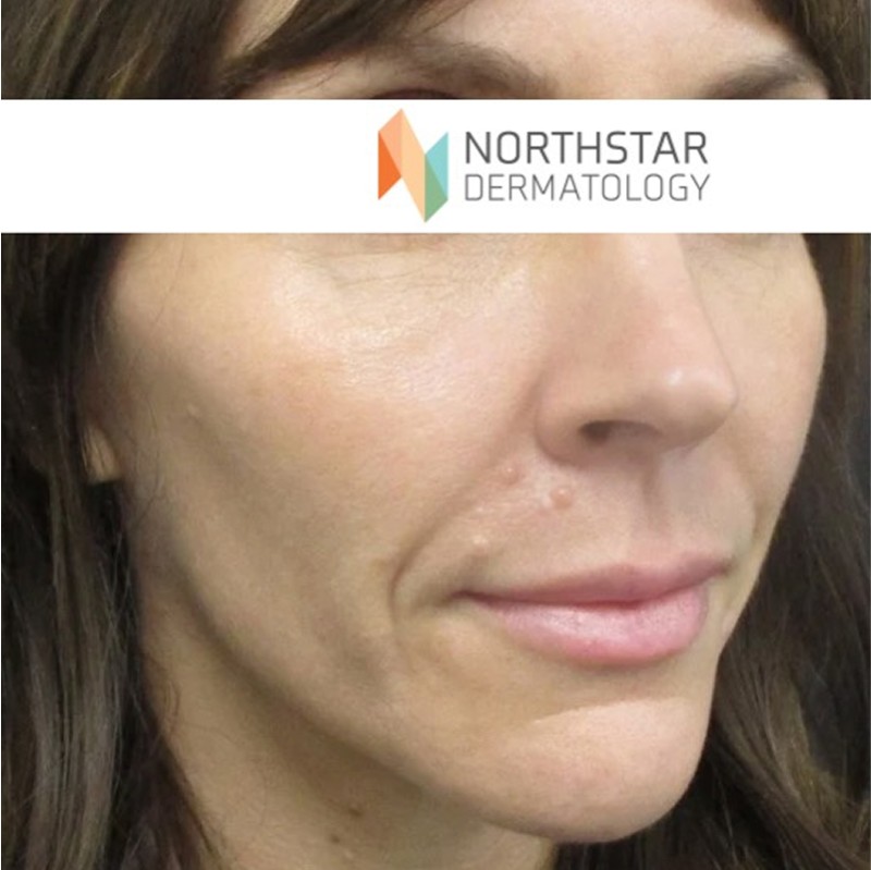 Juvederm dermal filler - cheeck & lips.2